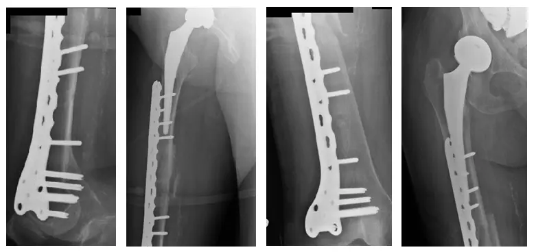 Fracture périprothétique 2 Fracture périprothétique 2