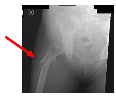 fémur oblique 1 fémur oblique 1