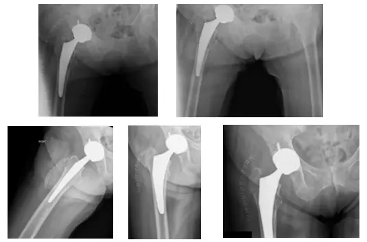 fracture de la hanche droite 2 fracture de la hanche droite 2