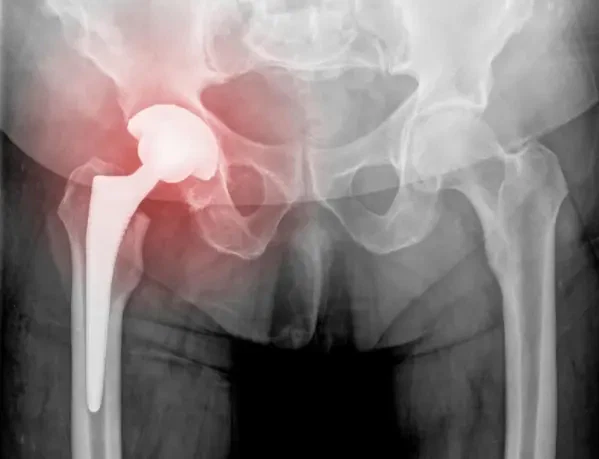 Chirurgie de remplacement de la hanche