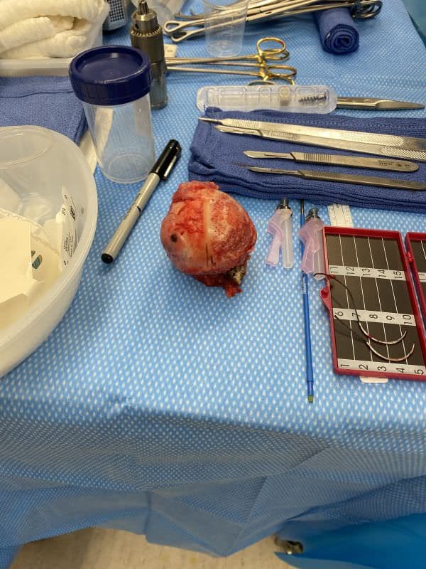 Respected femoral head 2 Respected femoral head 2