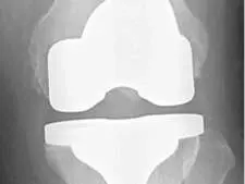 Remplacement du genou