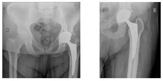 hip-xray1 hip-xray1