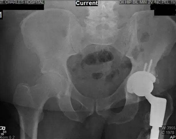 hip-xray5 hip-xray5