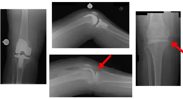 Espaciador antibiótico articulado 1