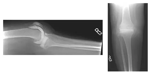 Espaciador antibiótico articulado 2