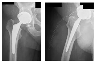 Artritis de cadera 2