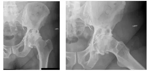 Artritis de cadera 3