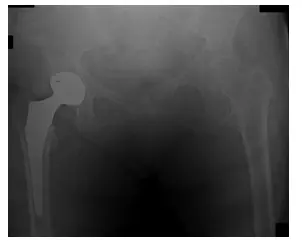 Por qué la artroplastia total de cadera (ATC) es mejor que la prótesis parcial de cadera