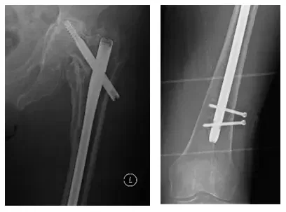 Reconstrucción de cadera 1