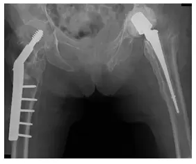 Reconstrucción de cadera 3