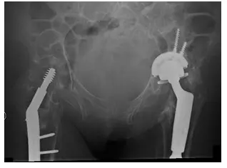 Reconstrucción de cadera 4