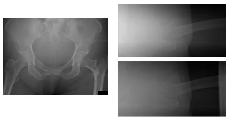 Hip Revision 1