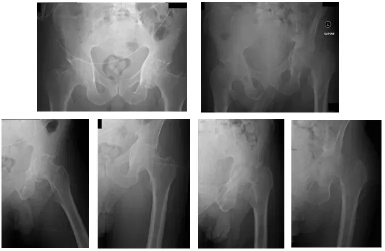 Native Hip with Arthritis 1