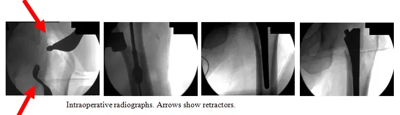 Native Hip with Arthritis 2