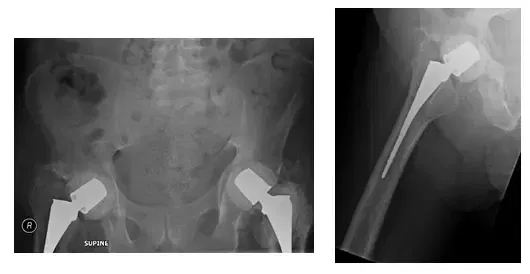 Native Hip with Arthritis 5