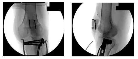 Reducción abierta Fijación interna 2