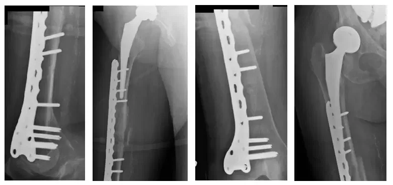 Fracture périprothétique 2 Fracture périprothétique 2