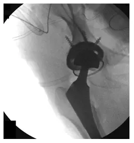 Estudio de caso de luxación recurrente de artroplastia total de cadera (ATC)