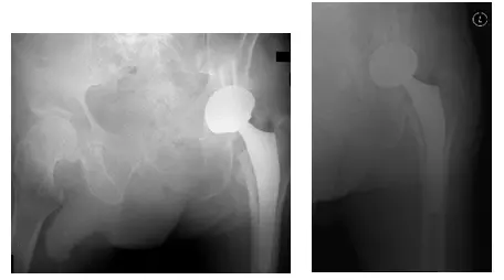 Total Hip Arthroplasty 2
