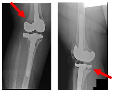 Total Knee Replacement 2 Total Knee Replacement 2