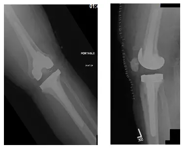 Total Knee Replacement 3 Total Knee Replacement 3