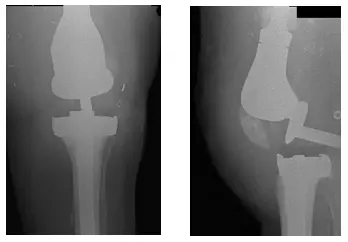 Estudio de caso de prótesis tumoral luxada | Dr. Nakul Karkare