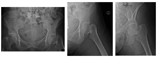 caderas bilaterales 1