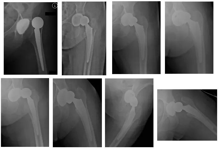 caderas bilaterales 2