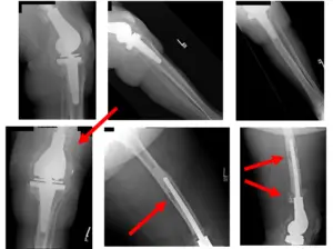 femoral and tibial 1 femoral and tibial 1
