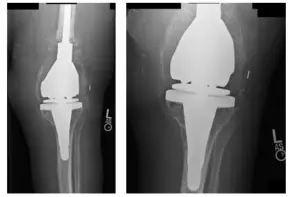 femoral and tibial 2 femoral and tibial 2