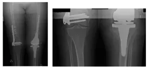 femoral and tibial 3 femoral and tibial 3