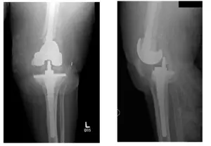 femoral and tibial 4 femoral and tibial 4