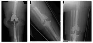 femoral and tibial 5 femoral and tibial 5