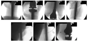 femoral and tibial 6 femoral and tibial 6