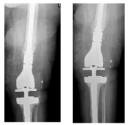 femoral and tibial 7 femoral and tibial 7