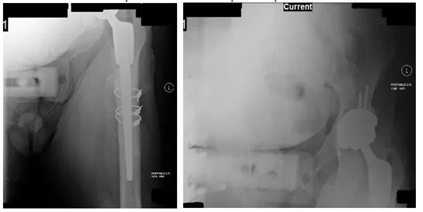 Étude de cas sur l’arthroplastie totale de la hanche infectée (THA)