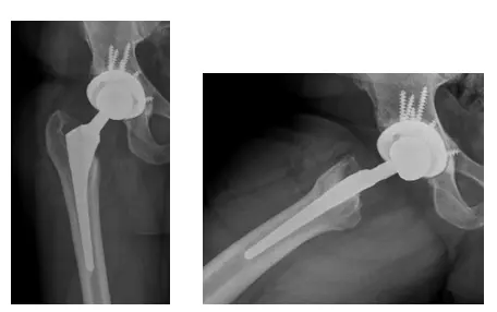 Estudio de un caso de ferretería dolorosa