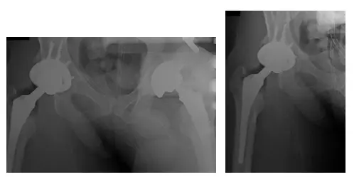 prótesis de cadera 2