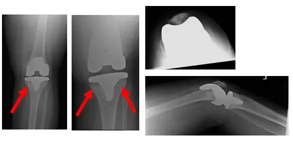 Total Knee Replacement 1 Total Knee Replacement 1