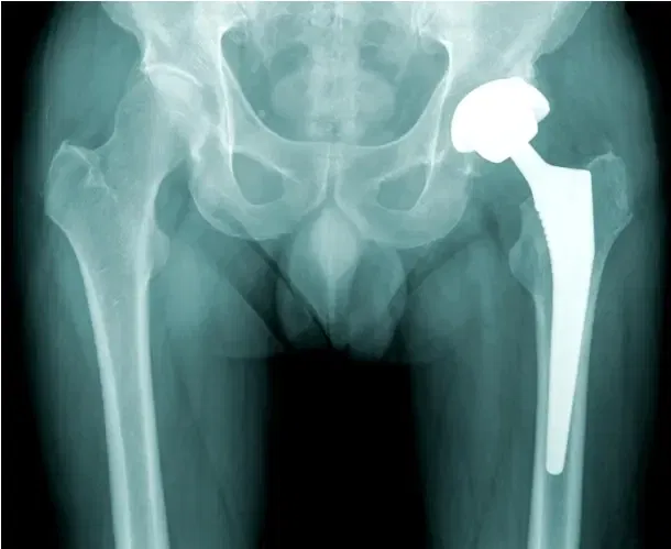 revisión de cadera revisión de cadera