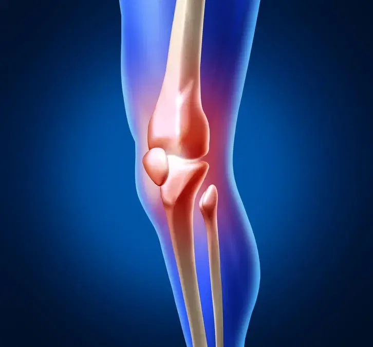 When Do You Need a Knee Replacement?