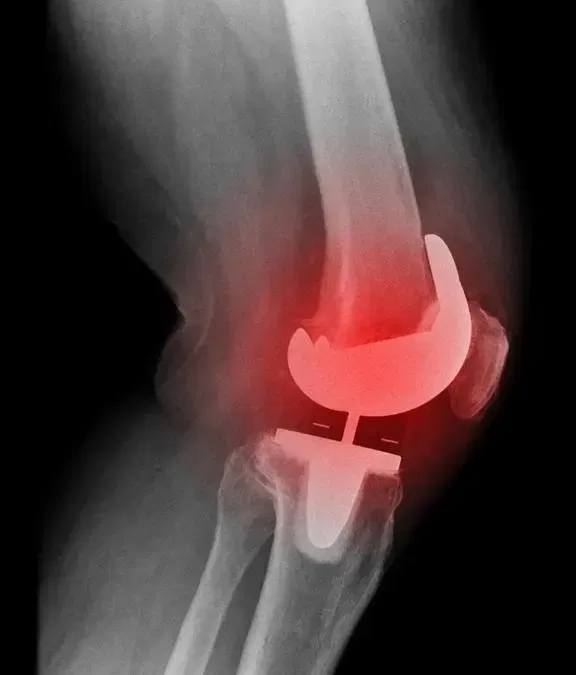 Prepare Yourself Better for Knee Replacement Revision Recovery