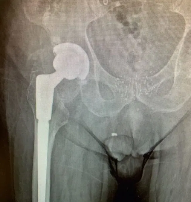 JF – Hip Replacement Revision Surgery | NY, USA
