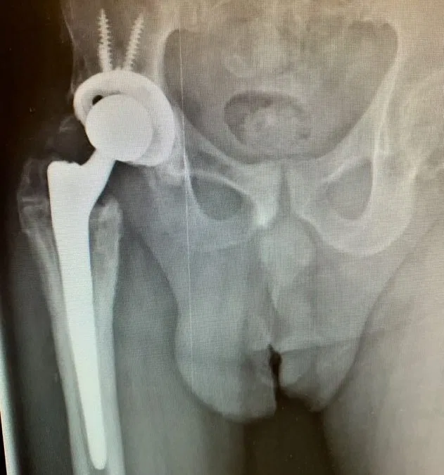 Case Study: LR – Revision Hip Replacement