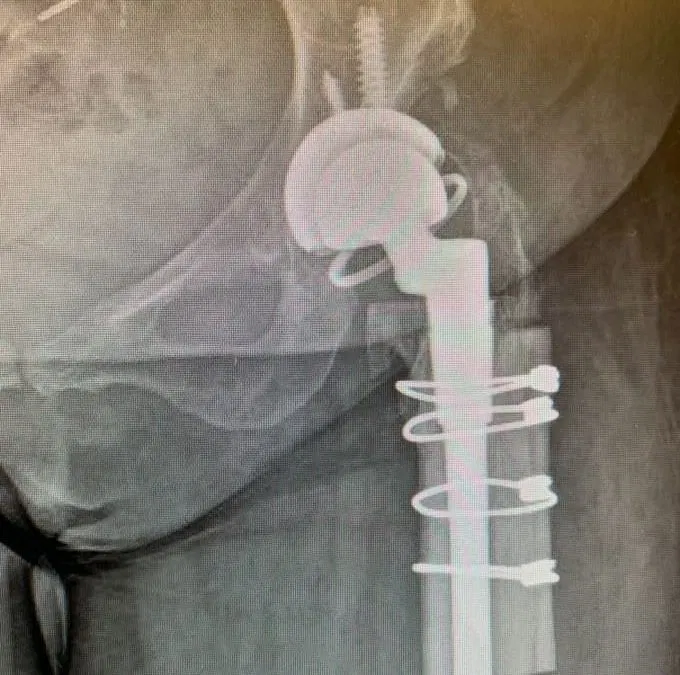 Case Study: WM – Revision Hip Replacement