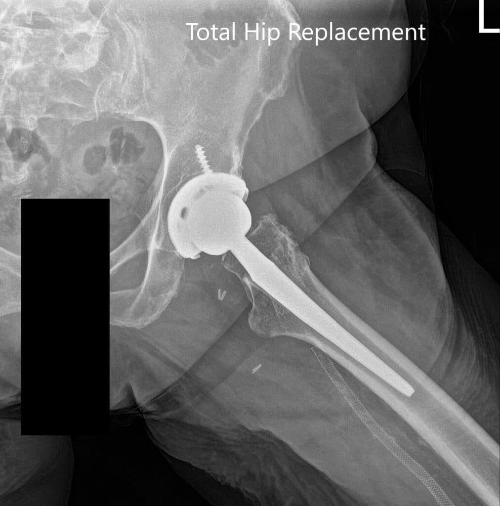 Hip Xray 2 Hip Xray 2