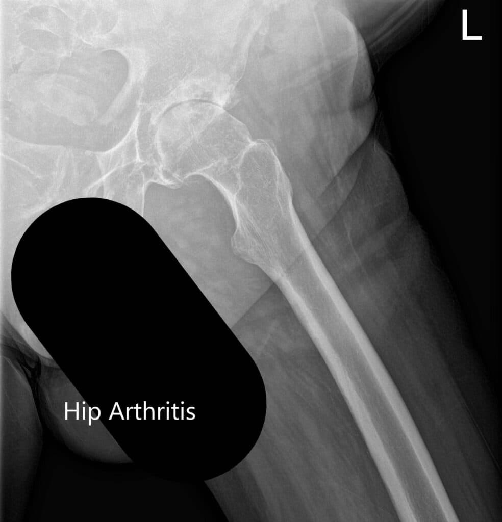 Hip Xray 3 Hip Xray 3