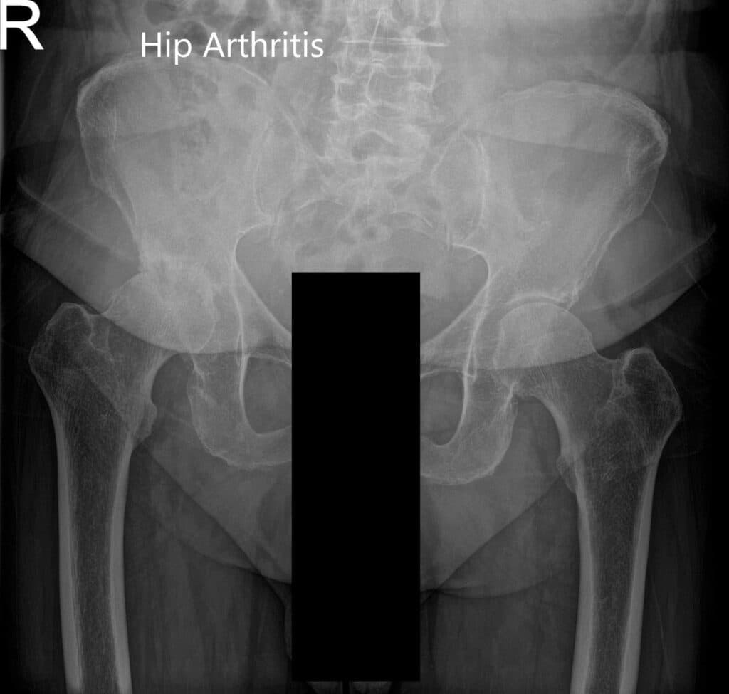Hip Xray 4 Hip Xray 4