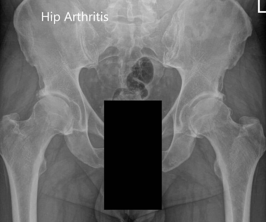 Hip Xray 5 Hip Xray 5